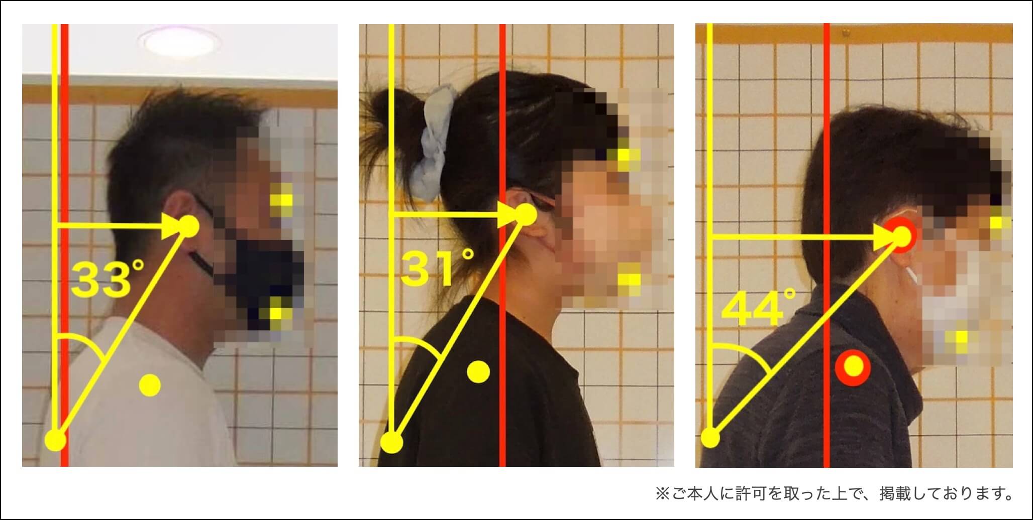 頭突き出し姿勢についての参考例
